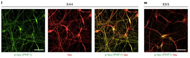 Alzheimer Hastalığı... nörofibriller yumaklar